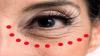 Hoe om rimpels rond de ogen te wissen