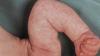"Marmeren" huid bij baby's: norm of pathologie? Neuroloog antwoorden