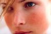Rosacea: Oorzaken ongezond blush en de behandeling ervan