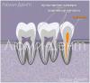 Hoe tandkanalen te vinden en te behandelen in Lumident