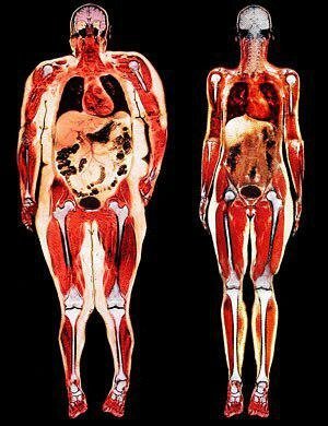 Links - net viscerale obesitas. Alle organen gesmoord met vet.