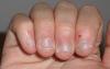 Hoe afleren zijn nagels bijten?