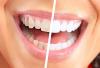 Hoe zich te ontdoen van de plaque en witter hun tanden thuis