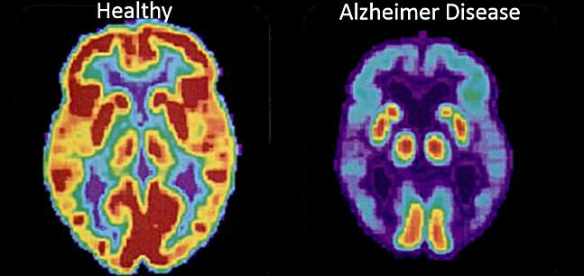 Het eerste beeld - de hersenen van een gezonde persoon, de tweede - de ziekte van Alzheimer 