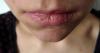 Hoe gemakkelijk te genezen gebarsten lippen