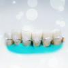 Populaire spalken tanden: hoeveel het effectief?