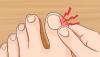Hoe zich te ontdoen van nagel schimmel thuis