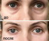 Een goedkope masker 40 roebel correctie nasolacrimal grooves: het resultaat na de eerste toepassing. Schoonheidsspecialist is niet meer nodig