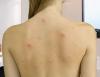 Hoe zich te ontdoen van acne op je rug