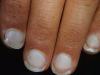 Waarom witter vingernagels