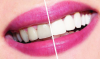 Hoe kunt u uw tanden witter te maken thuis? tandheelkundige advies.