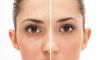 4 krachtige tools om zich te ontdoen van de poriën op het gezicht