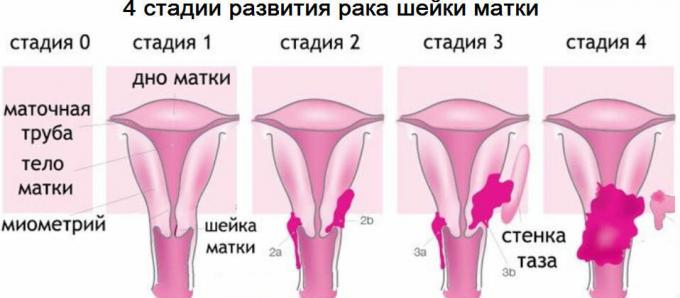 4 stadia van baarmoederhalskanker
