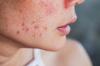 Hoe u uw huid kunt opruimen na de zomer: thuis- en salonbehandelingen