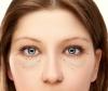 Hoe zich te ontdoen van zonder chirurgie, een hernia en onderste oogleden ogen zakken