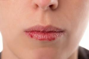 5 tips over hoe om te chapping van de lippen te voorkomen